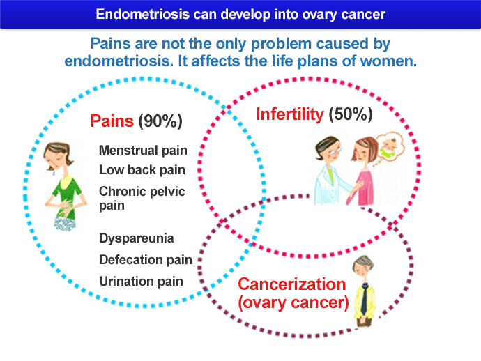 Endometriosis can develop into ovary cancer Pains are not the only problem caused by endometriosis. It affects the life plans of women.