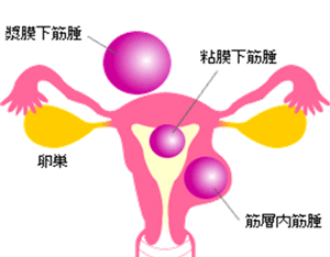 小さく する 筋腫 子宮