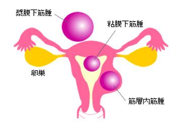 図1子宮筋腫